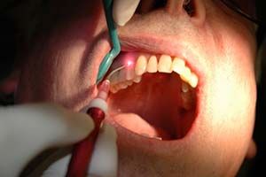 Dental laser